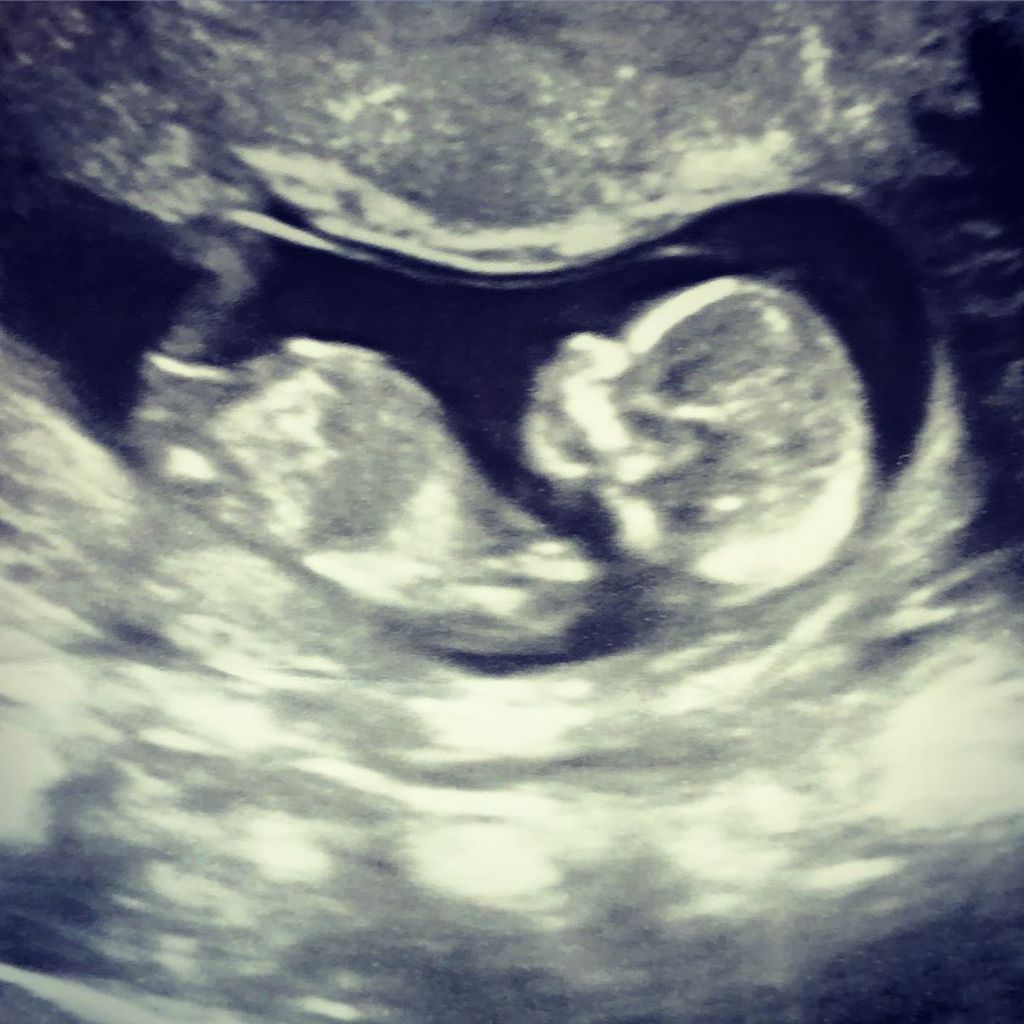 Ultraschallbild des dritten Kindes von Mackenzie Edwards