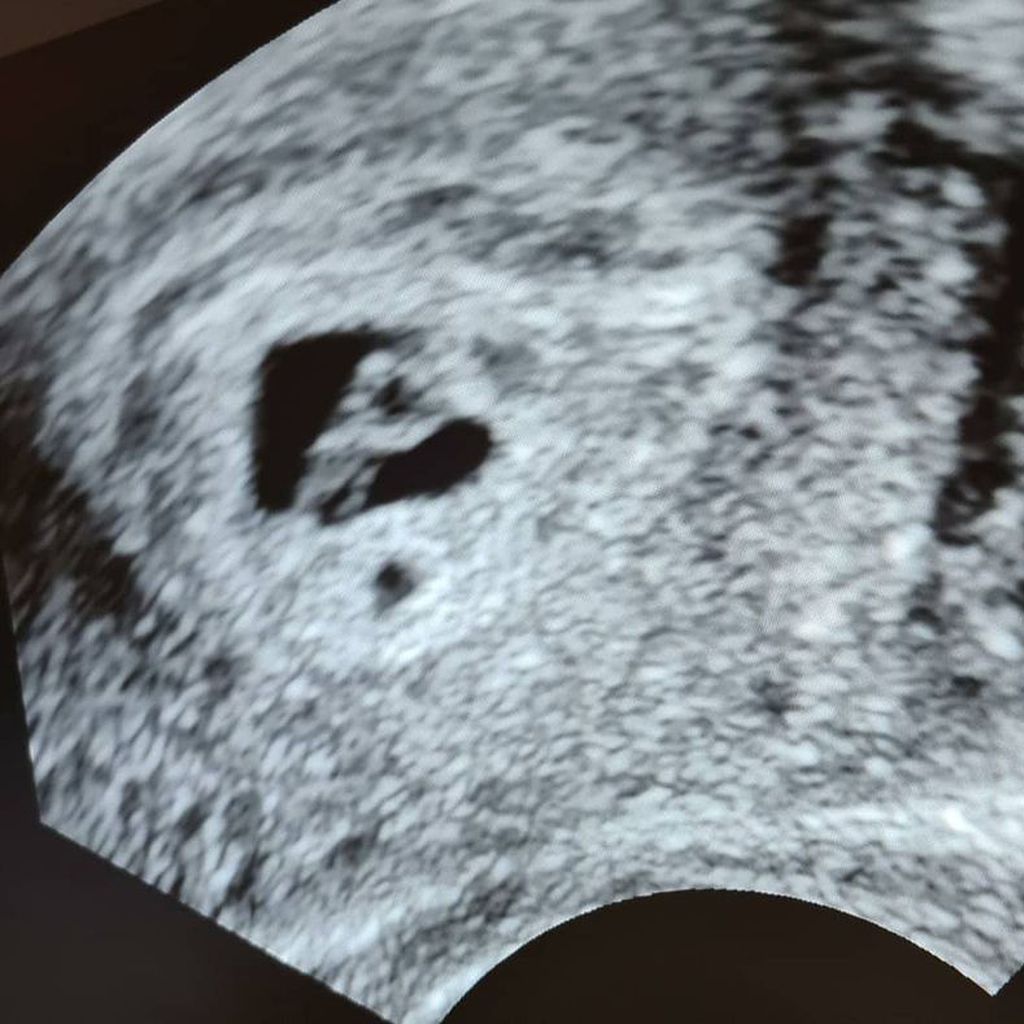 Silvia Wollny postet ein Ultraschallbild