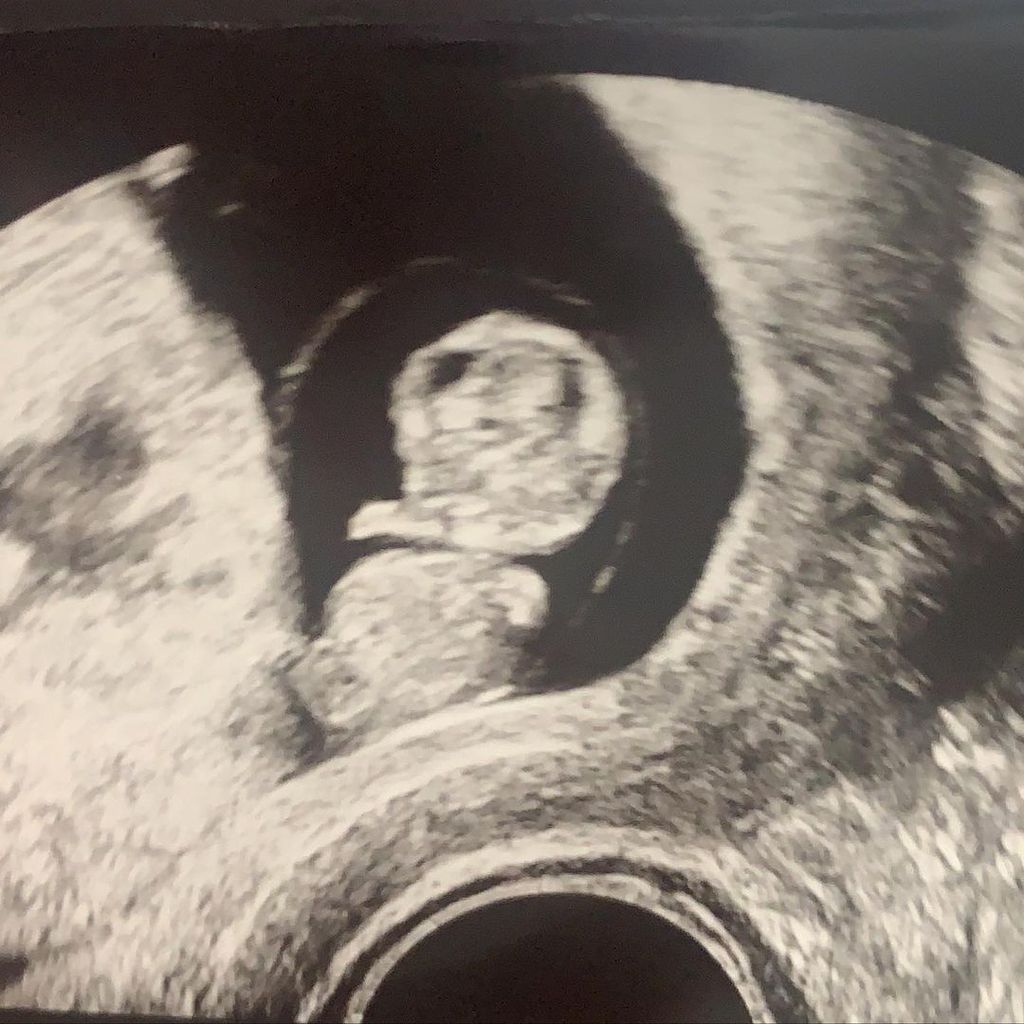 Ultraschallbild von Alex Reids Baby