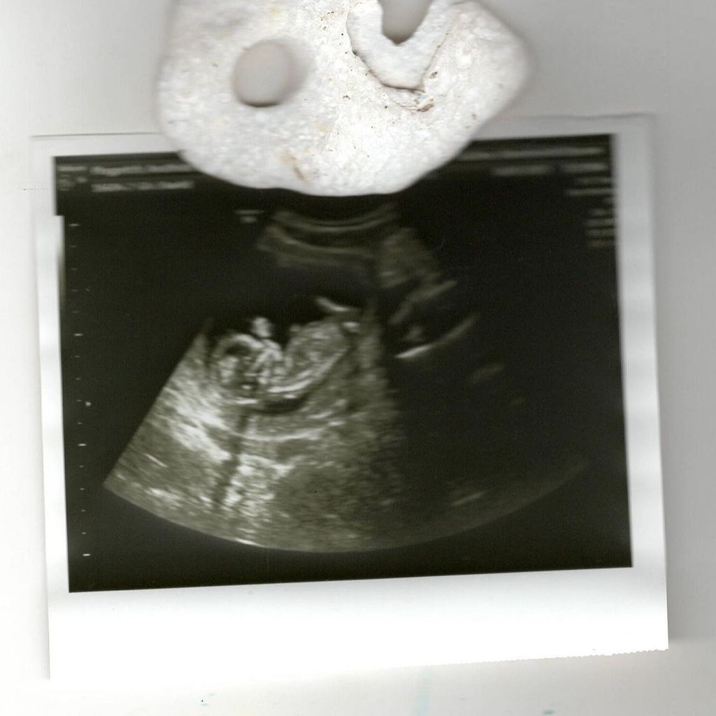 Ultraschallbild von Anuthida Ploypetchs Baby