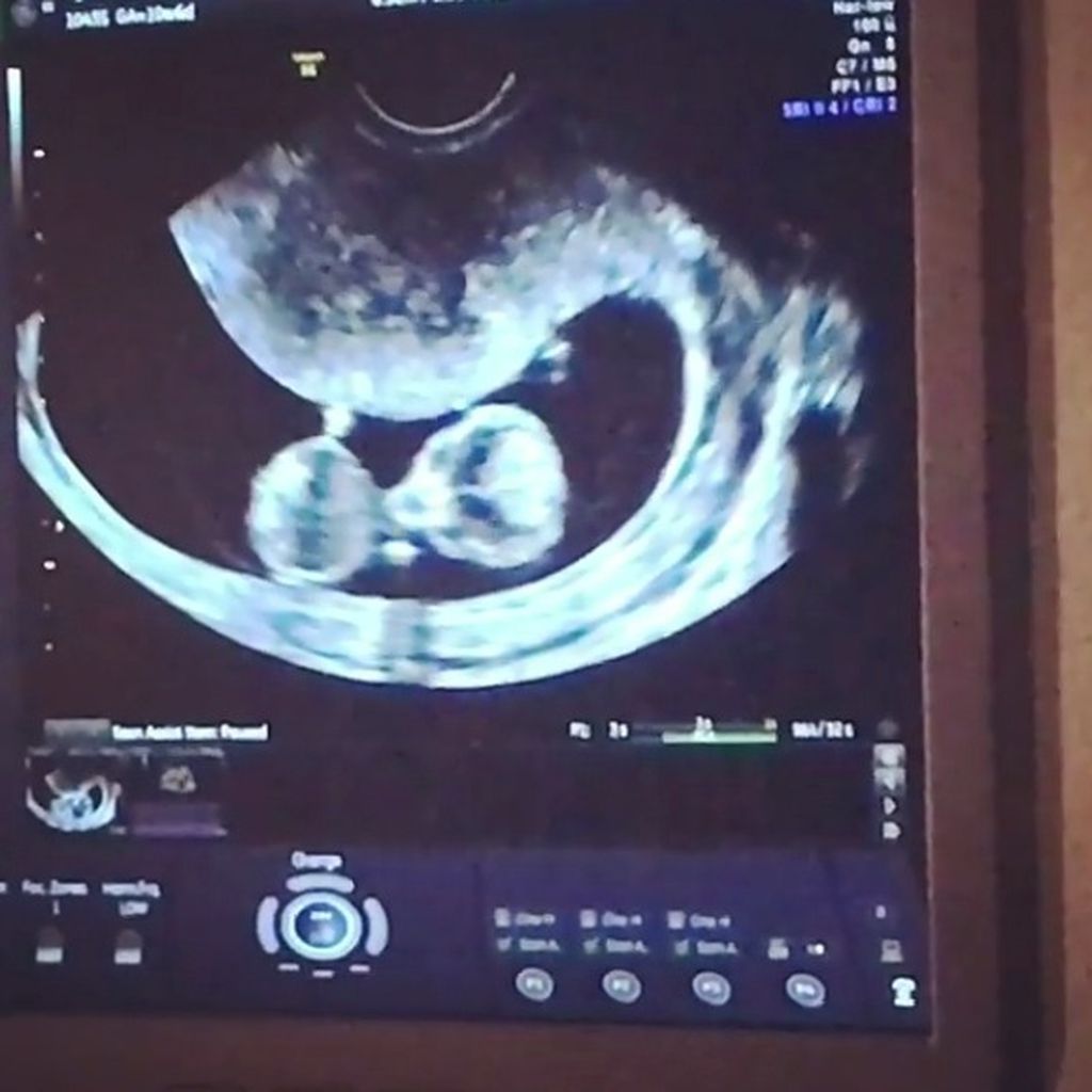 Ultraschallbild von Britt Nilssons Baby