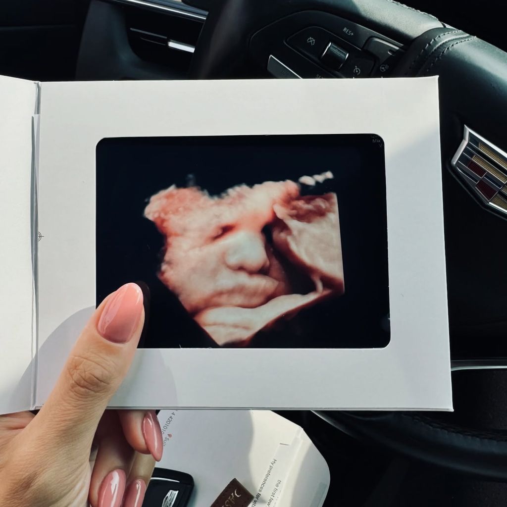 Ultraschallbild von Fiona Erdmanns Baby