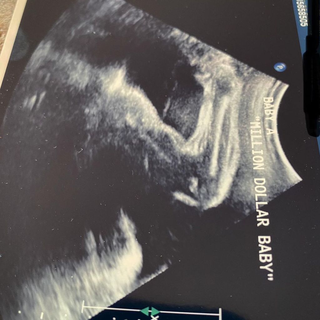 Ultraschallbild von Hilary Swank