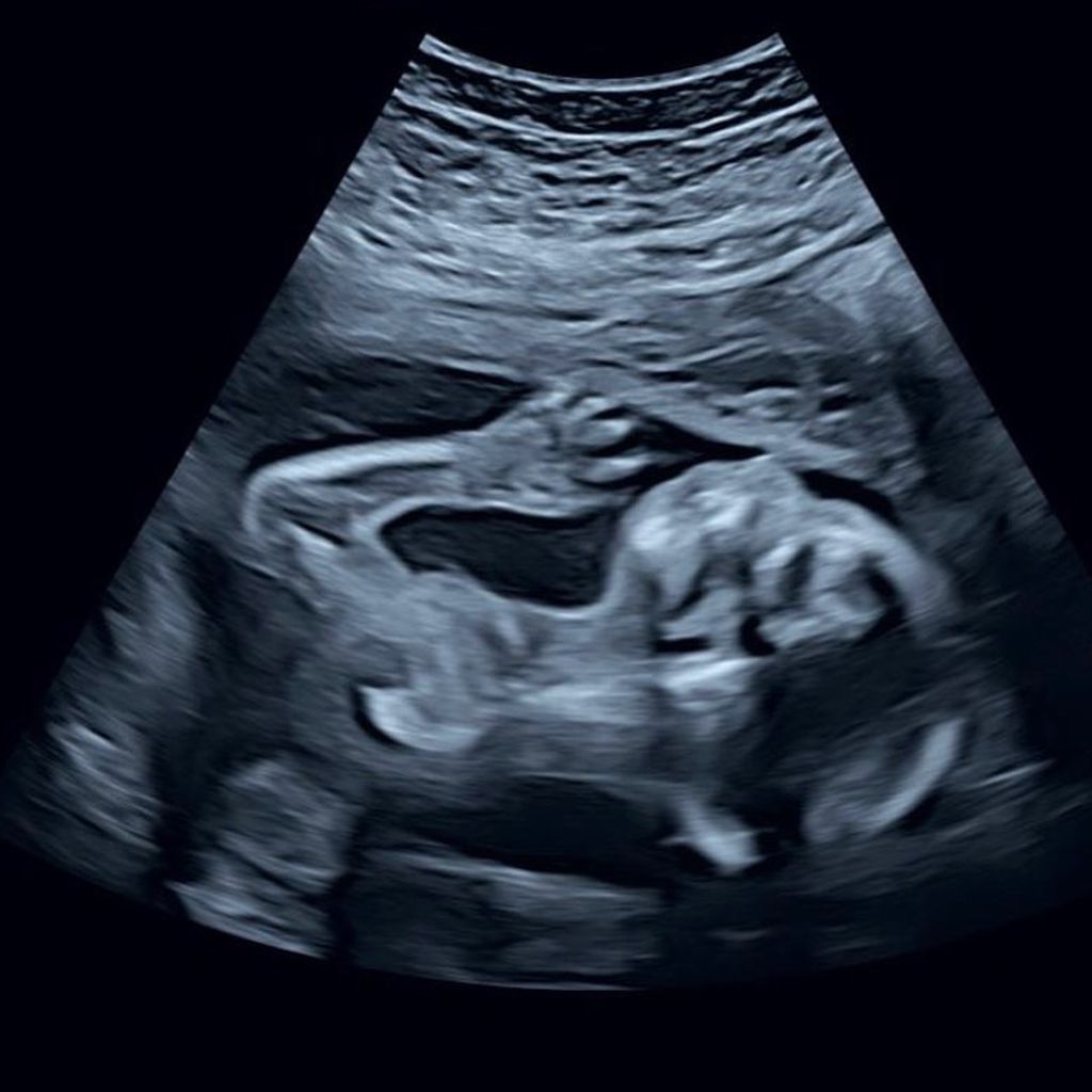 Baby von Jana Schölermann auf einem Ultraschallbild, September 2021