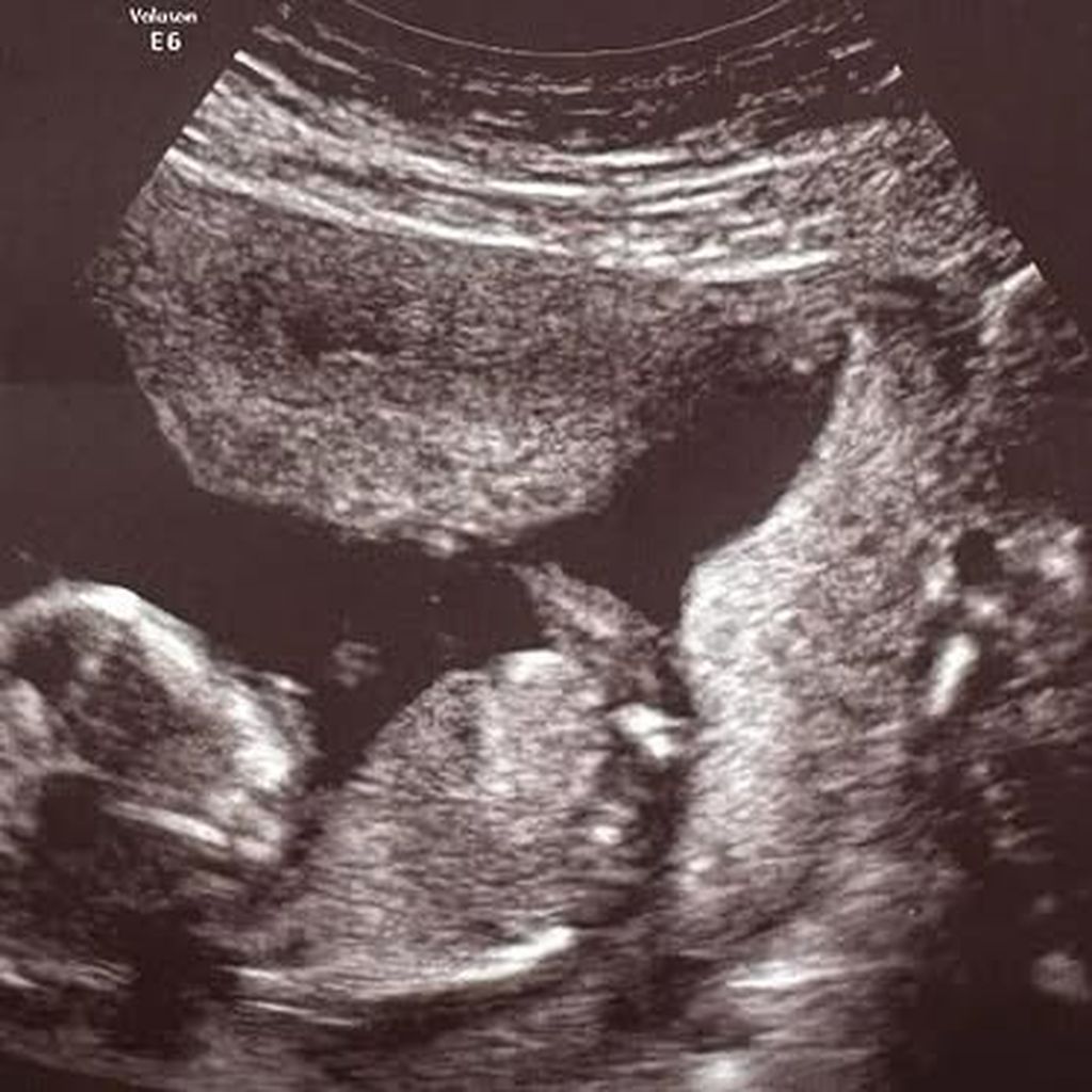 Ultraschallbild von Lennart Borcherts Baby