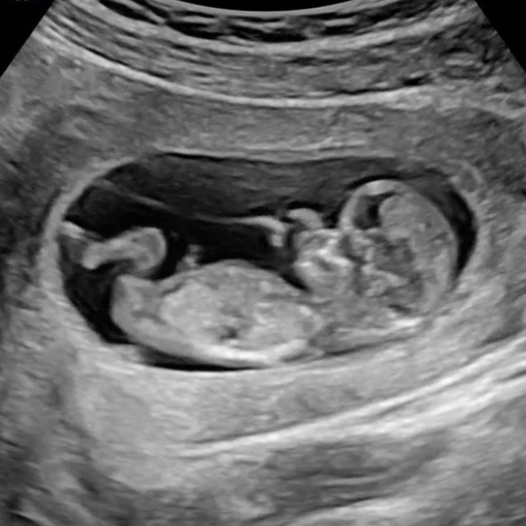 Ultraschallbild von Nicola Adams und Ella Baigs Baby