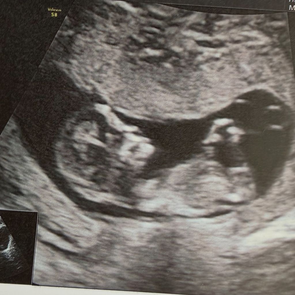 Ultraschallfoto von Laura Woods' Baby