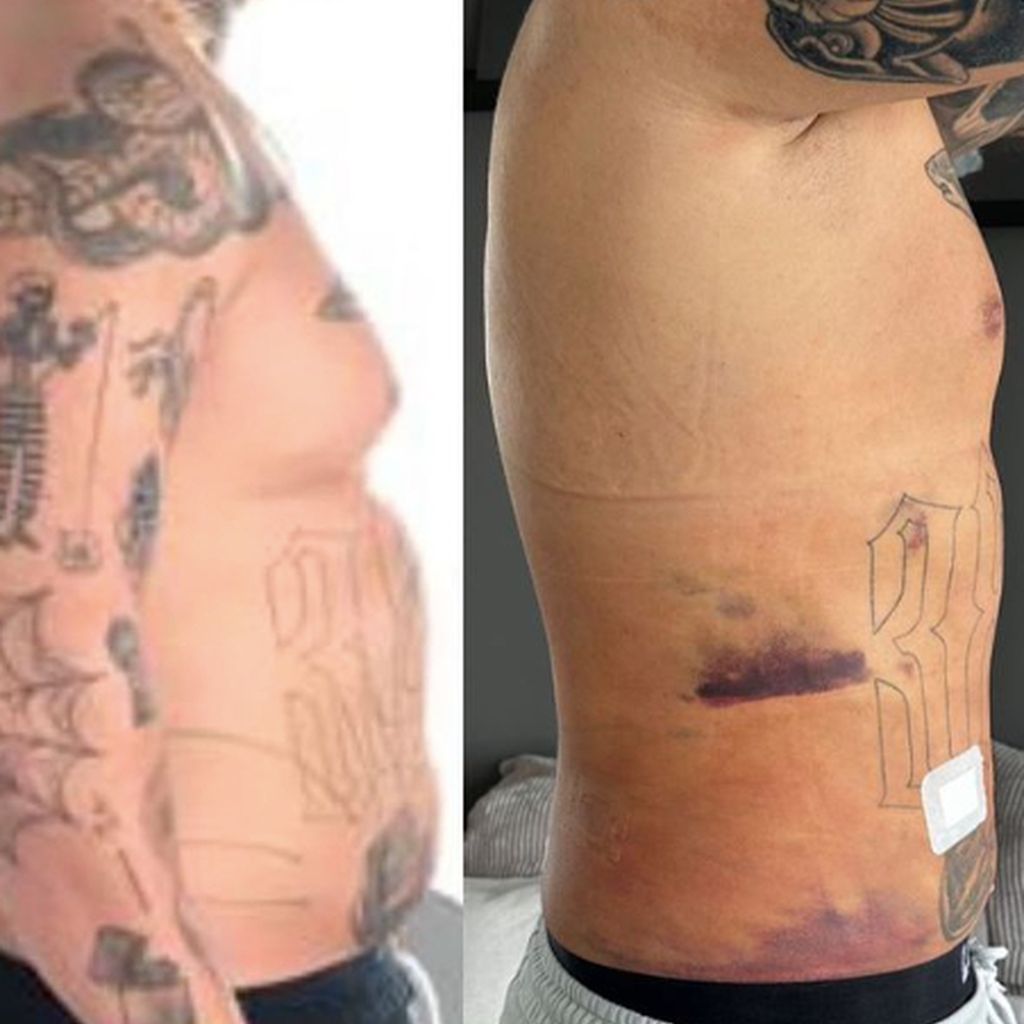 Zico Banach vor und nach seiner Fettabsaugung
