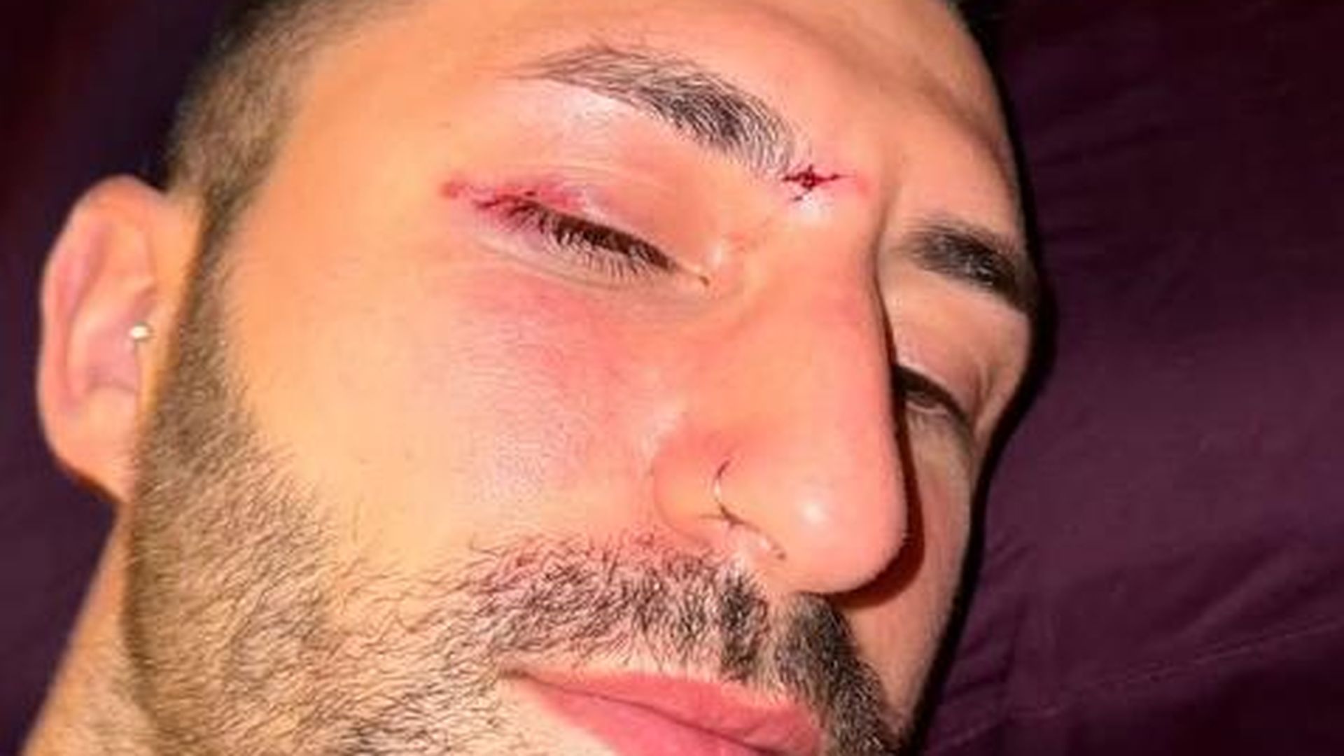 Wegen-Albtraum-Fabio-De-Pasquale-verlor-fast-sein-Auge