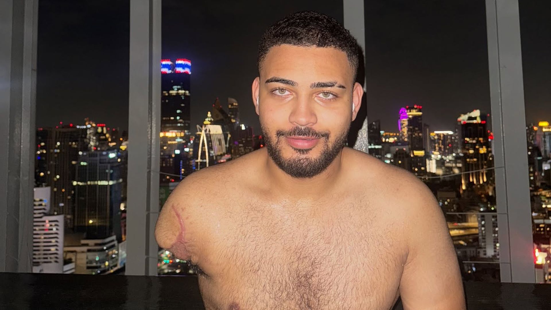 Influencer-Justin-Bunyai-spricht-offen-ber-den-Armverlust