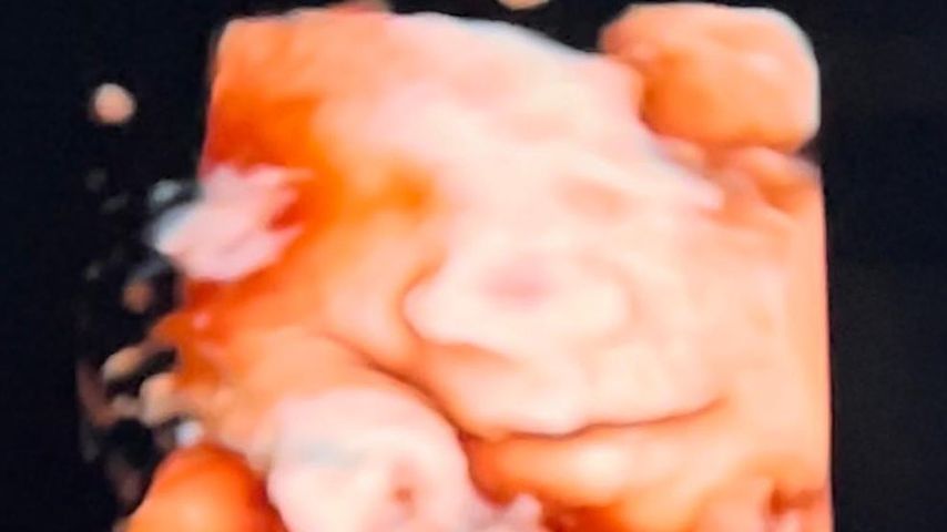3D-Ultraschallbild von Jessie J's Baby