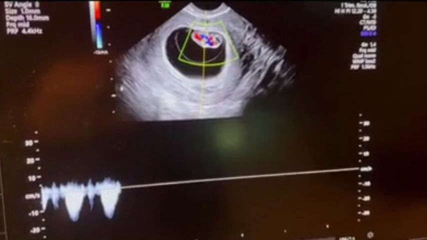Adriana Limas Ultraschallbild von ihrem Baby