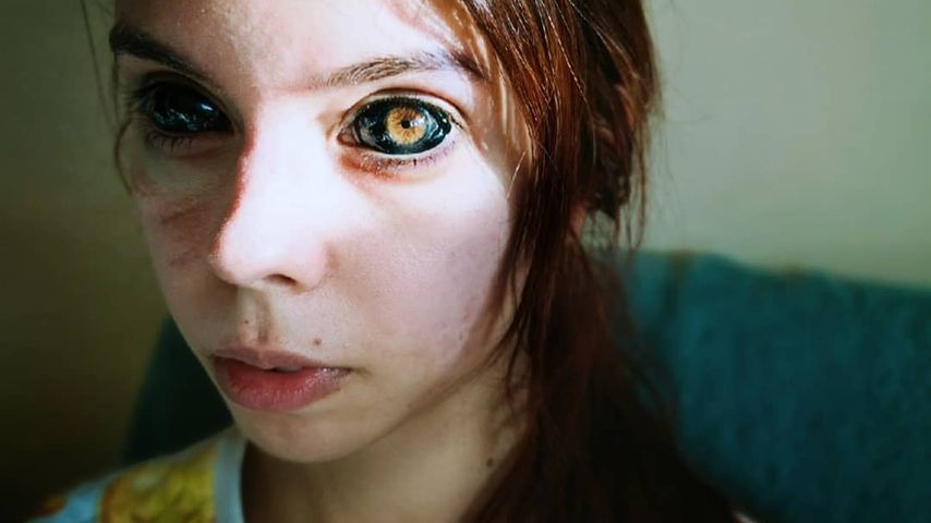 Dank Augen-Tattoos: 25-jährige Influencerin ist jetzt blind!