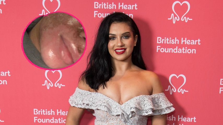 Horror-Pics: "Love Island"-Star zeigt Beauty-OP-Folgen