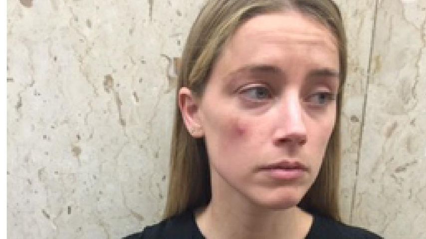Amber Heard zeigt Prügelfotos: Warf Johnny Handy nach ihr?