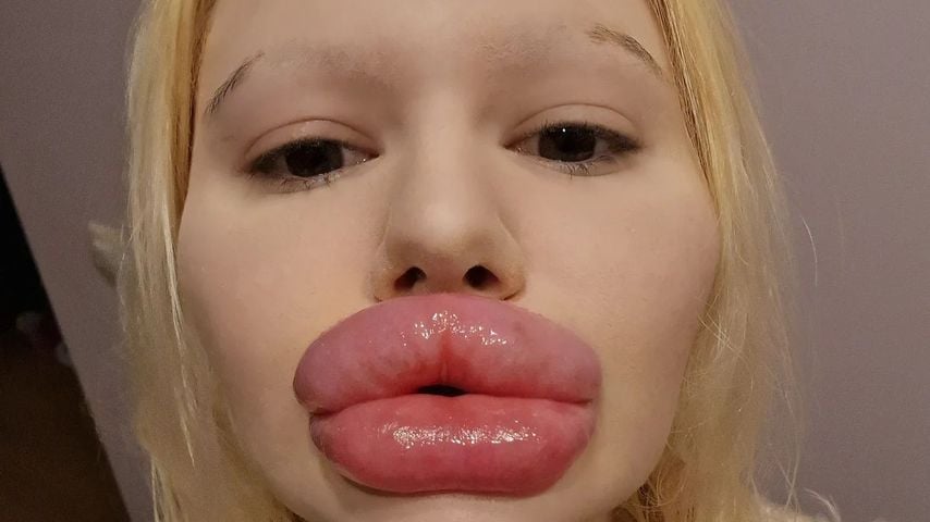 Nach Mega-Lippen: Andrea Ivanova will komplett neues Gesicht