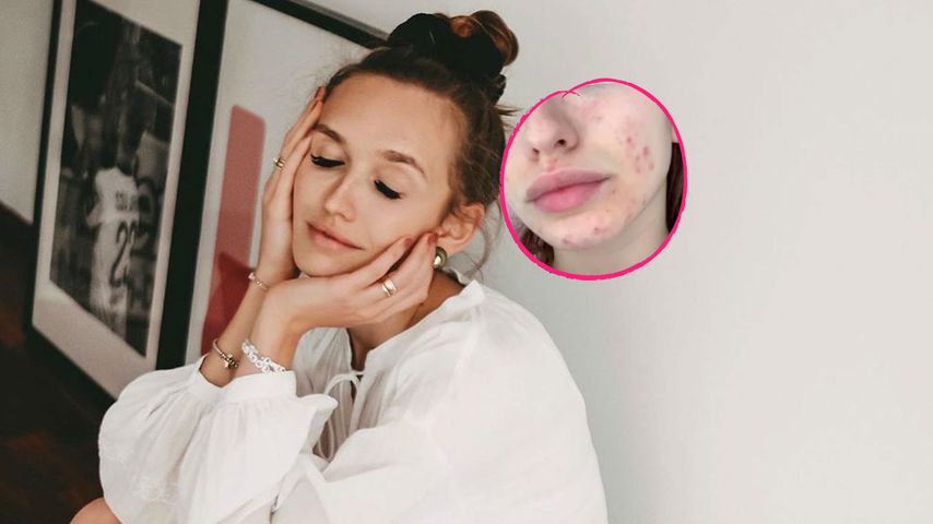 Ehrliche Fotos: Model Anna Wilken hatte früher starke Akne