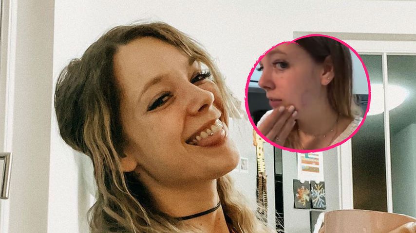 Fans in Sorge: Anne Wünsches Freund hat sie gebissen