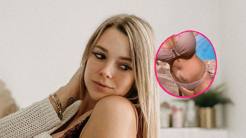 Mutiges Bild: Anne Wünsche steht zu ihren Dehnungsstreifen
