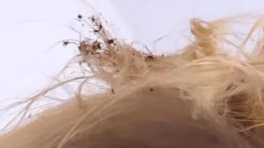 Anne Wünsches Haare nach Kerzen-Unfall im Juli 2024
