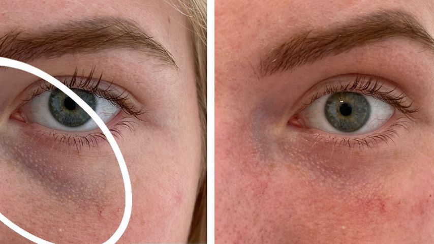 Antonia Hemmer vor (links) und nach (rechts) der Augenringunterspritzung