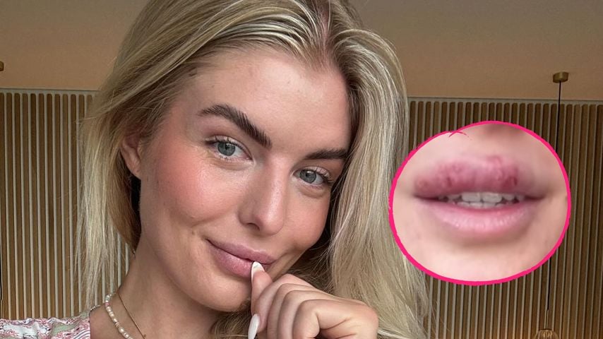 Antonia Hemmer hat nach einem Partywochenende krassen Herpes