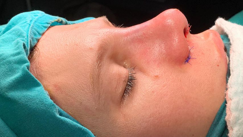 Arielle Rippegather nach ihrer Nasen-OP