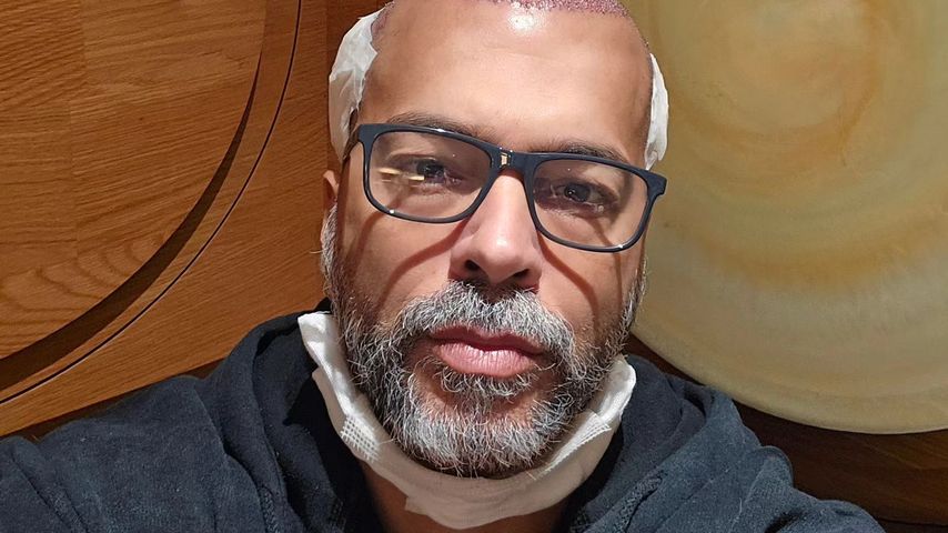 Transplantation: Aurelio Savina hat erst jetzt volles Haar