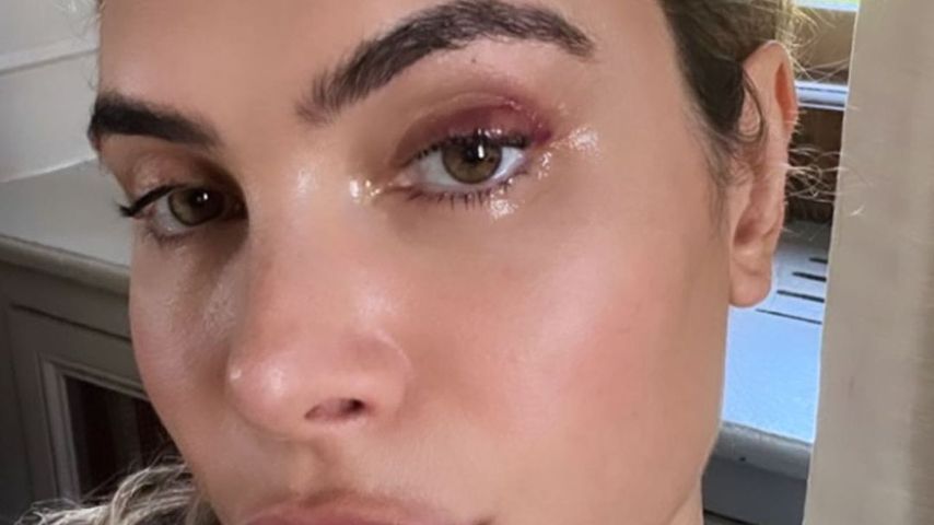 Nach chirurgischem Eingriff: Ayda Field hat ein blaues Auge