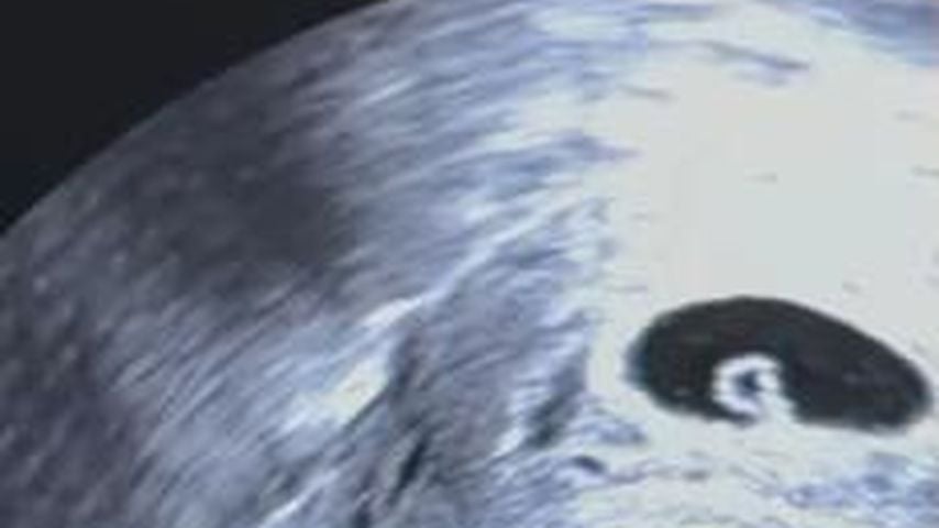 Babu zeigt eine Ultraschallaufnahme von ihrem verlorenen Baby