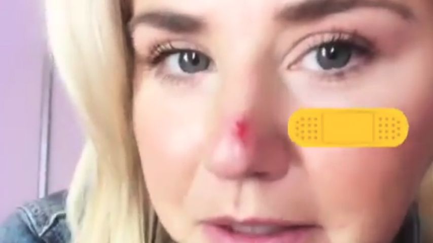 Autsch! Beatrice Egli schrammt sich Nase an der Tür auf