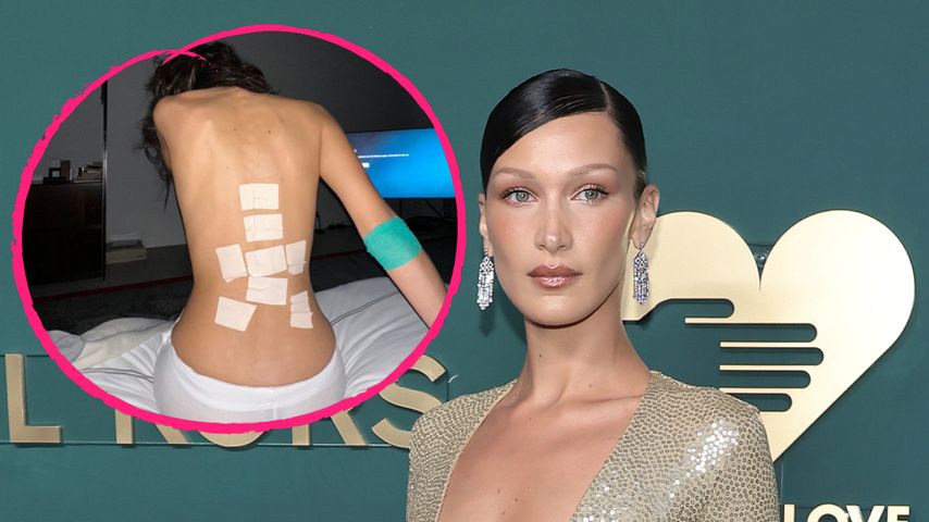 Pflaster und Hämatome: Fans sind besorgt um Bella Hadid