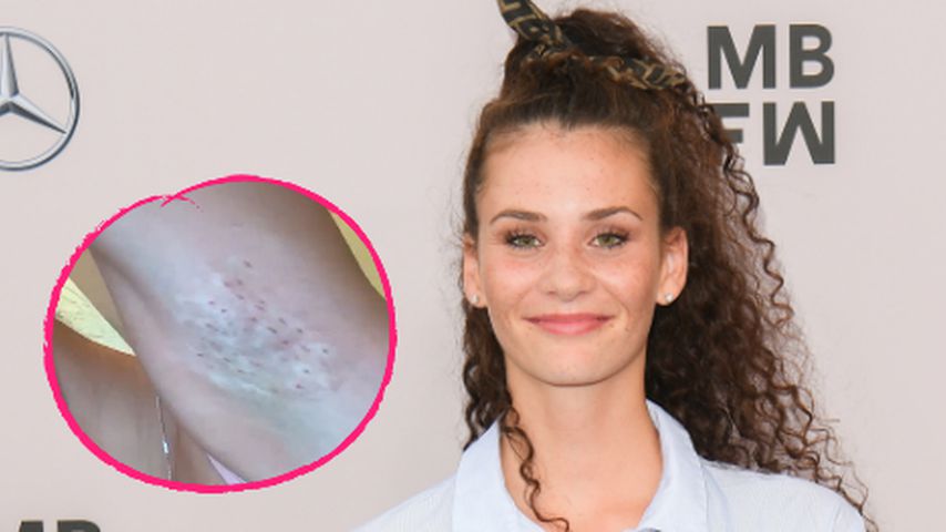 GNTM-Betty Taube lässt sich Botox in die Achseln spritzen