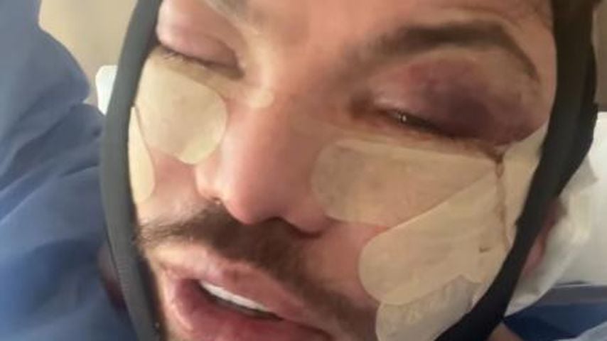 Bobby Norris nach seinem Facelift mit 39 Jahren