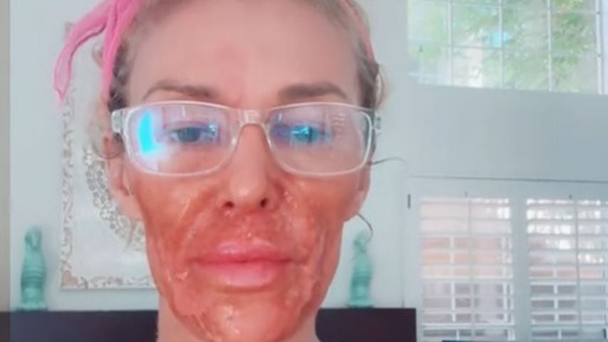 Brandi Glanville erleidet Gesichtsverbrennungen durch Creme