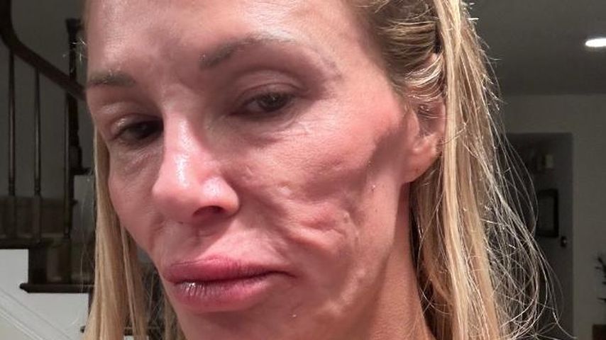 Wegen Gesicht: Brandi Glanville isoliert sich zunehmend