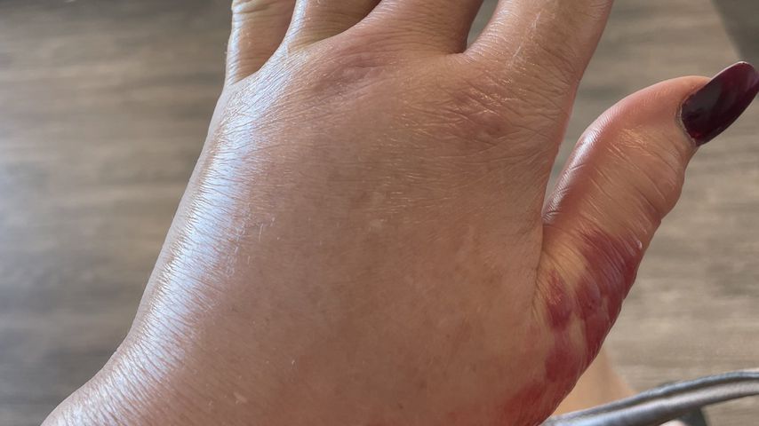 Brandi Glanvilles geschwollene Hand im August 2021