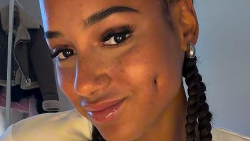 "Steht mir": Brenda Brinkmann ließ sich Grübchen modellieren