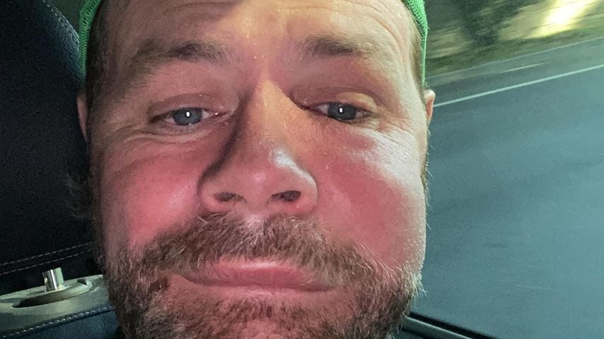 Nach Bienenstich: Brian McFaddens Gesicht total geschwollen