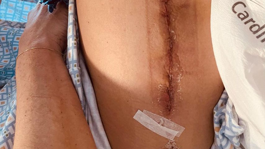 Brooke Shields Bein nach einem Unfall