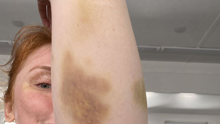 Bryce Dallas Howard mit blauen Flecken