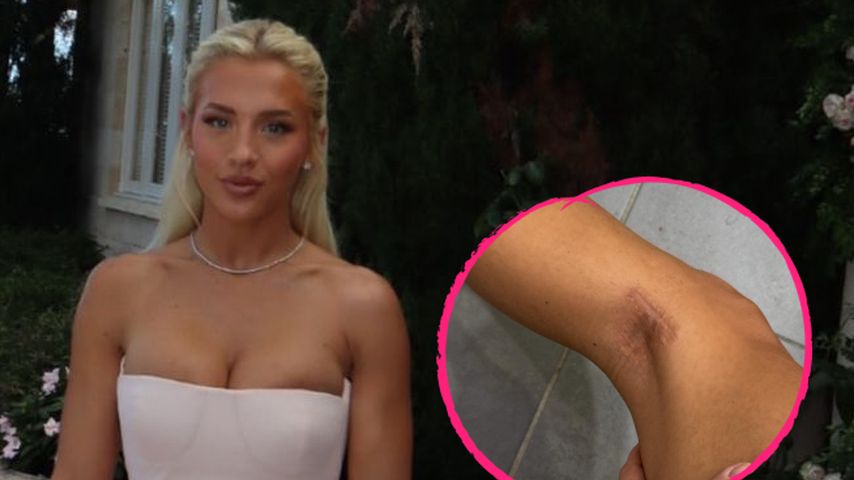 Collage: Tammy Hembrow und ihre Hautkrebsnarbe
