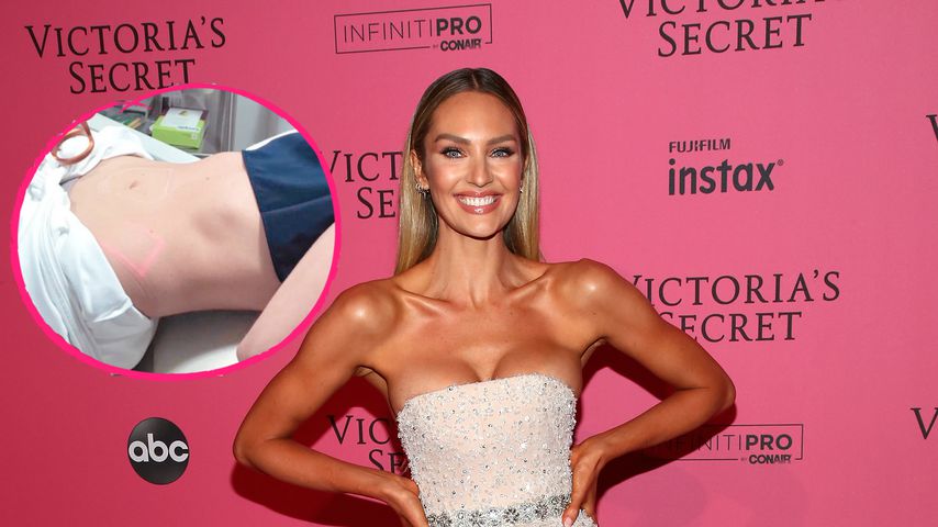 Babyplanung durch? Candice Swanepoel lässt Bauch straffen