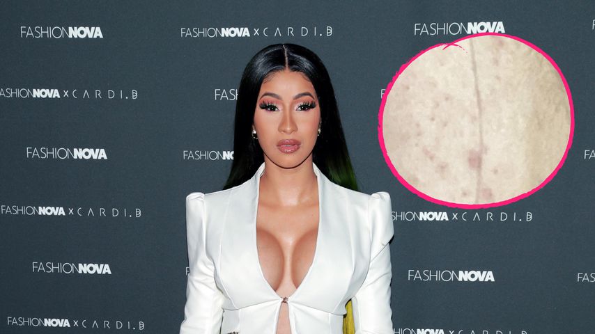Wegen Hautproblemen: Cardi B sucht Rat bei ihren Followern