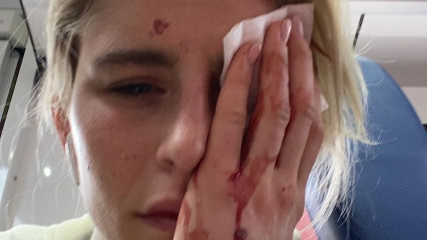Beim Joggen verletzt: Caro Daur muss blutend ins Krankenhaus