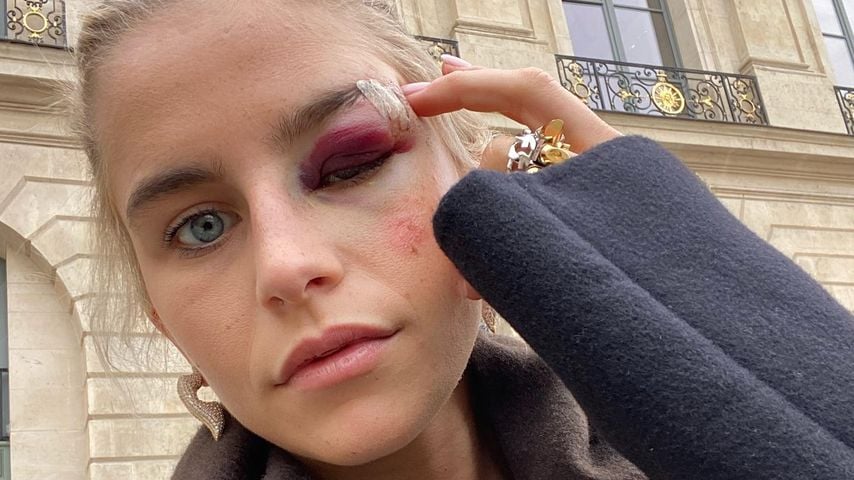 Nach Unfall: Caro Daur mit fettem Veilchen auf Fashion Week