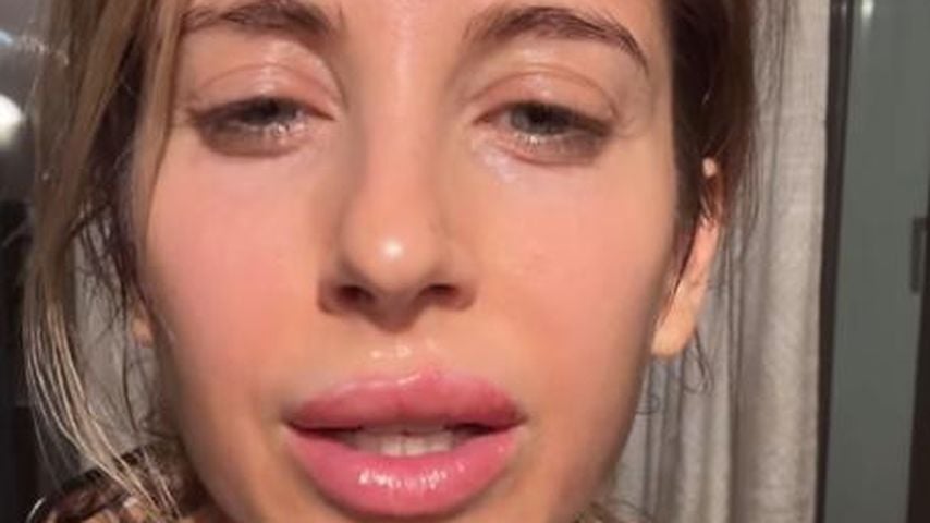 Keine Filler in den Lippen: Cathy Hummels hat dicken Herpes
