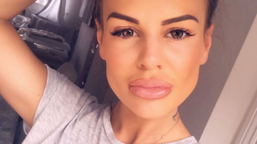 Zu viel des Guten? Chantelle Connelly zeigt XXL-Lippen