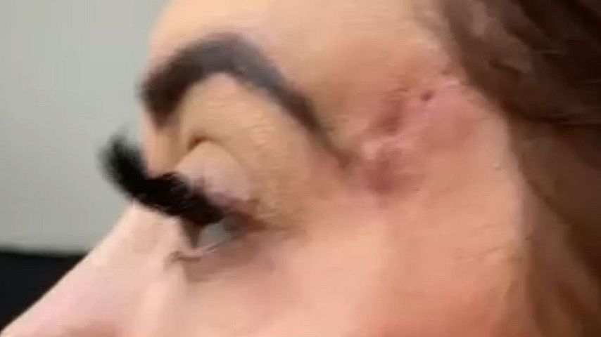 Chloe Ferry zeigt ihre OP-Narben