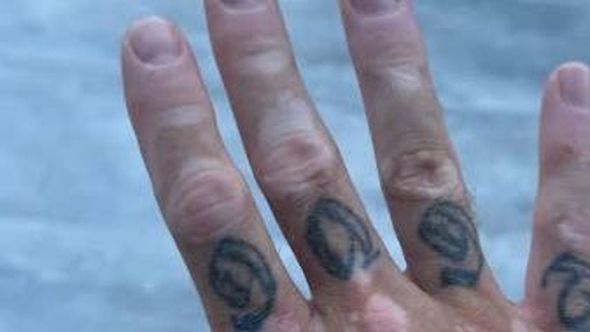 Chris Broys Vitiligo